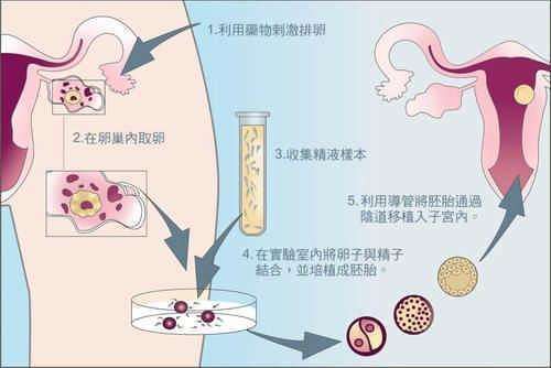 借卵子做试管婴儿行吗【借卵子做试管婴儿行吗?解读试管婴儿借卵子的利与弊】